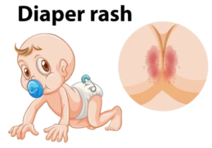 Baby Diaper Rash